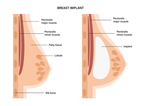 Breast Implant Concept
