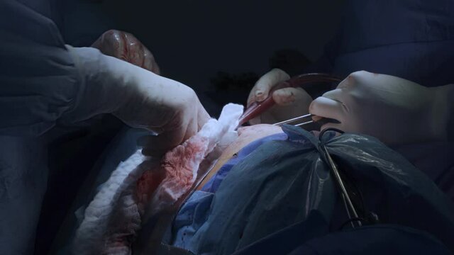 Thoracic surgeons performing a left lower lobe lung surgery. Medical themes