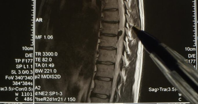 A Sagittal View Magnetic Resonance Image or MRI of Lumbar Spine Showing Ruptured Intervertebral Disc Herniation