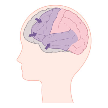 前頭側頭型認知症の脳のイラスト_前頭葉と側頭葉の萎縮