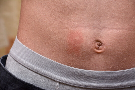 Pityriasis Rosea. Herpes. Red spots on the skin. Allergy. Weak immunity.