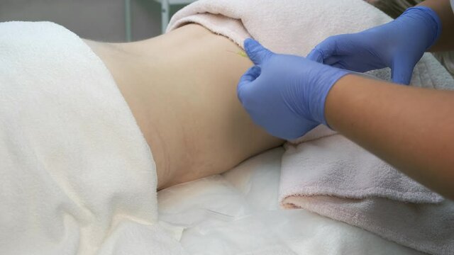 Doctor makes injection of ozone gas in patient abdomen on side on ozone therapy, closeup view. Treatment, cure and remove of skin tags and stretches. Cosmetologist woman in gloves.