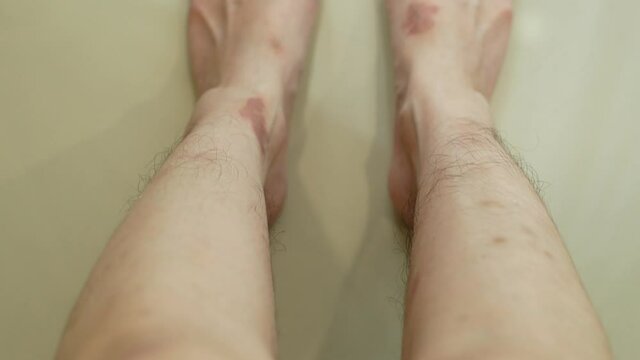 Close-up view of the eczema scars on the woman's leg.