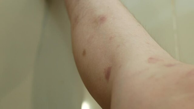 Close-up view of the eczema scars on the woman's leg.