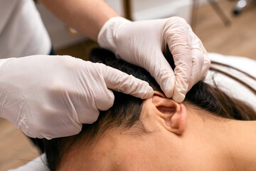 Obraz na płótnie Canvas Woman Receiving Acupuncture Treatment