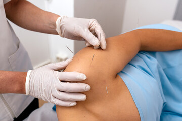 Fototapeta na wymiar Woman Receiving Acupuncture Treatment