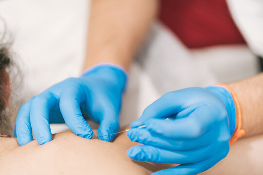 Closeup of crop anonymous therapist inserting needles in back of patient and helping relieving pain with acupuncture method