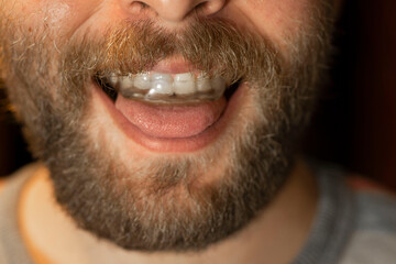 Fototapeta premium beard man with a discharge splint