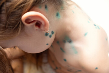 Portrait of little girl with pox . Sick child with chickenpox. Young toddler with chickenpox....