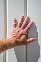 Hand and nails of a person with psoriasis and fungus
