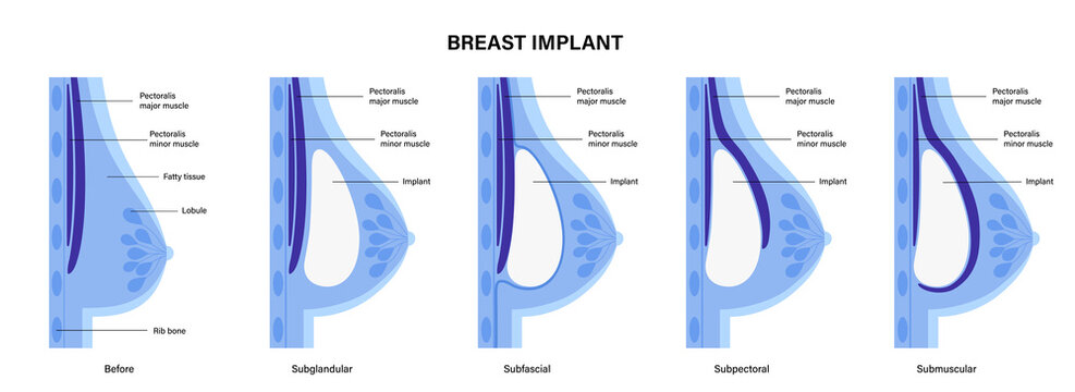 Breast Implant Concept