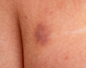 hematoma on the skin as a background