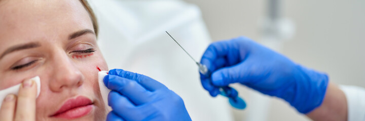 Woman getting cosmetic injection of botox near eyes, closeup. Woman in beauty salon. plastic surgery clinic