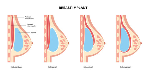 Breast Implant Concept - obrazy, fototapety, plakaty