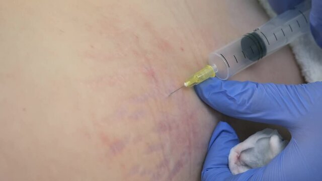 Doctor makes injection of ozone gas in patient woman on side of body on ozone therapy, closeup view. Treatment, cure and remove of skin tags and stretches. Correction of skin after pregnancy.