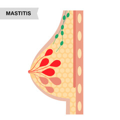 Breast disease concept