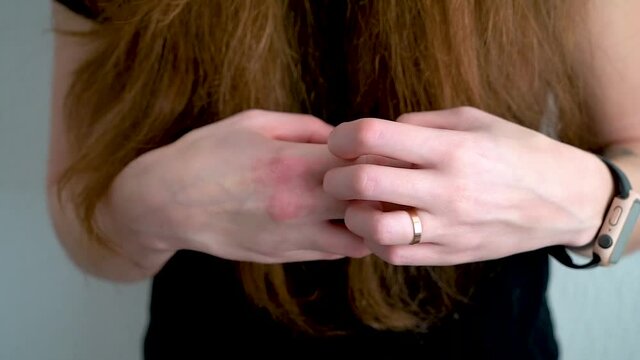 Itching close-up. Scratch your hand. The girl scratches her hand on a white background large. Allergies, dermatitis, scabies.