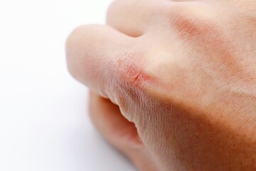 あかぎれ　手の乾燥 © umaruchan4678