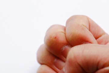 あかぎれ　手の乾燥