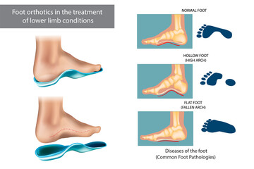 Diseases of the foot. Foot orthotics in the treatment of lower limb conditions