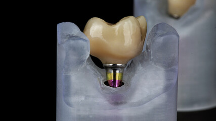 composition of the dental crown of the chewing tooth, no polymer model, filmed on a black background