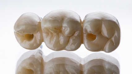 morphology of a dental bridge of three teeth on a white background