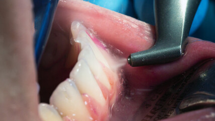 moment while cleaning the lower jaw, using a stream of water and powder