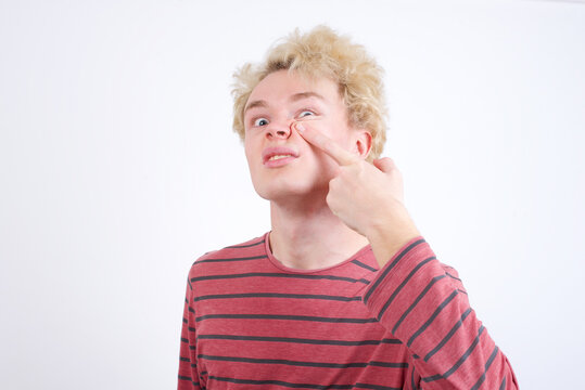 Young handsome Caucasian blond man standing against white background pointing unhappy to pimple on forehead, ugly infection of blackhead. Acne and skin problem
