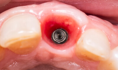 implant progile befor fixing the crown