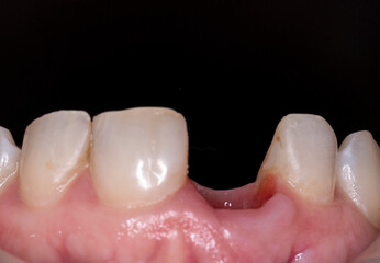tooth no 11 press ceramic crown on implant