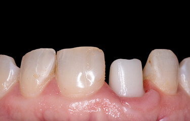zirkon abatment on implant