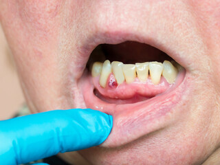 On the gum, an abscess formed, a tumor with purulent contents. Dentist examination.