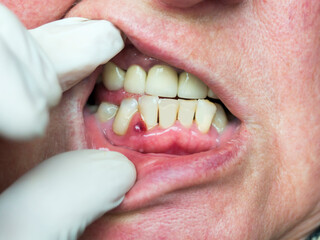 On the gum, an abscess formed, a tumor with purulent contents. Dentist examination.