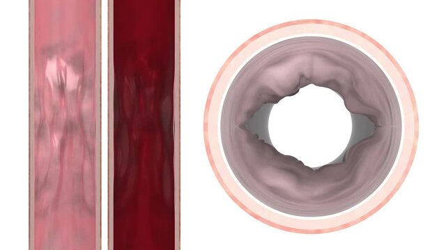 Recanalization of stenotic artery, medical visualization, stylized, 3d rendering, 3d illustration