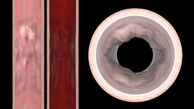 Recanalization of stenotic artery, medical visualization, stylized, 3d rendering, 3d illustration