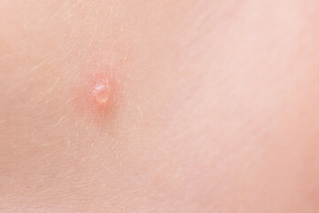 Fototapeta premium Close-up of a watery pimple on the skin from the disease chicken pox