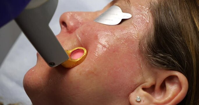 Woman receiving IPL facial treatment to remove blemishes and spider veins
