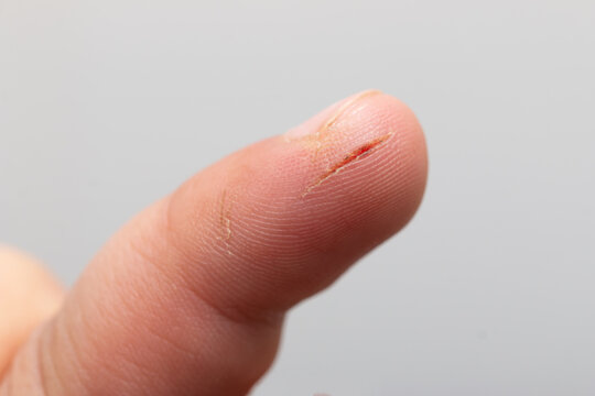 cut on the skin of a finger
