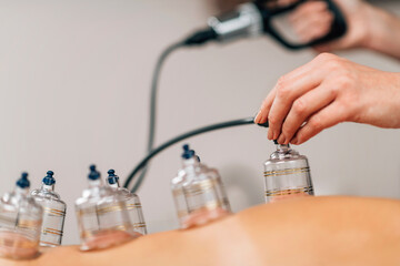 Cupping Therapy - Hijama