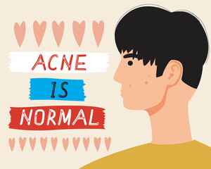 Acne man face, skin problems, flat vector stock illustration as a concept of acceptance of appearance, beauty of different skin