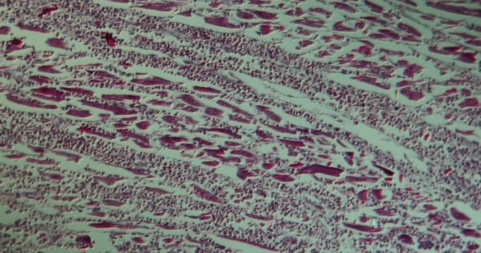 Myocarditis tissue under the microscope 100x