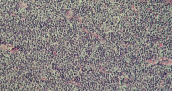malignant lymphoma tissue under the microscope 200x