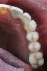 Obraz premium dental prosthesis for half the jaw in the patient's mouth
