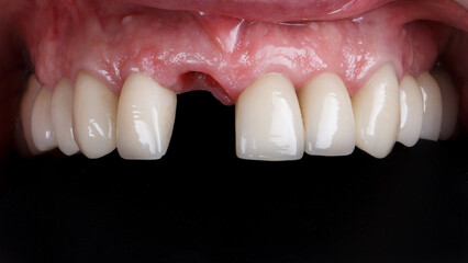 upper jaw without central incisor on a black background