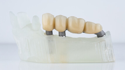 dental bridge on a beam, mounted on a polymer model on a light background