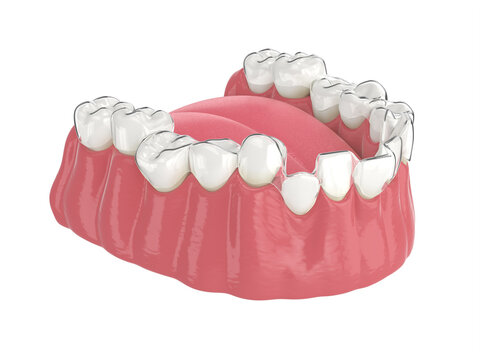 3d render of jaw with clear aligner splint