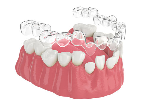 3d Render Of Jaw With Clear Aligner Splint