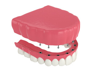 3d render of removable snap-on full implant denture installation