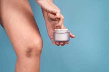 Woman applying cream on bruised knees. Knee injury, skin hematoma, skin repair concept.