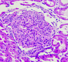 Photo of endocapillary hypercellularity in lupus nephritis, photo under microscope, magnification...